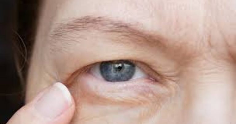 Best Ptosis Surgeon in Dhaka