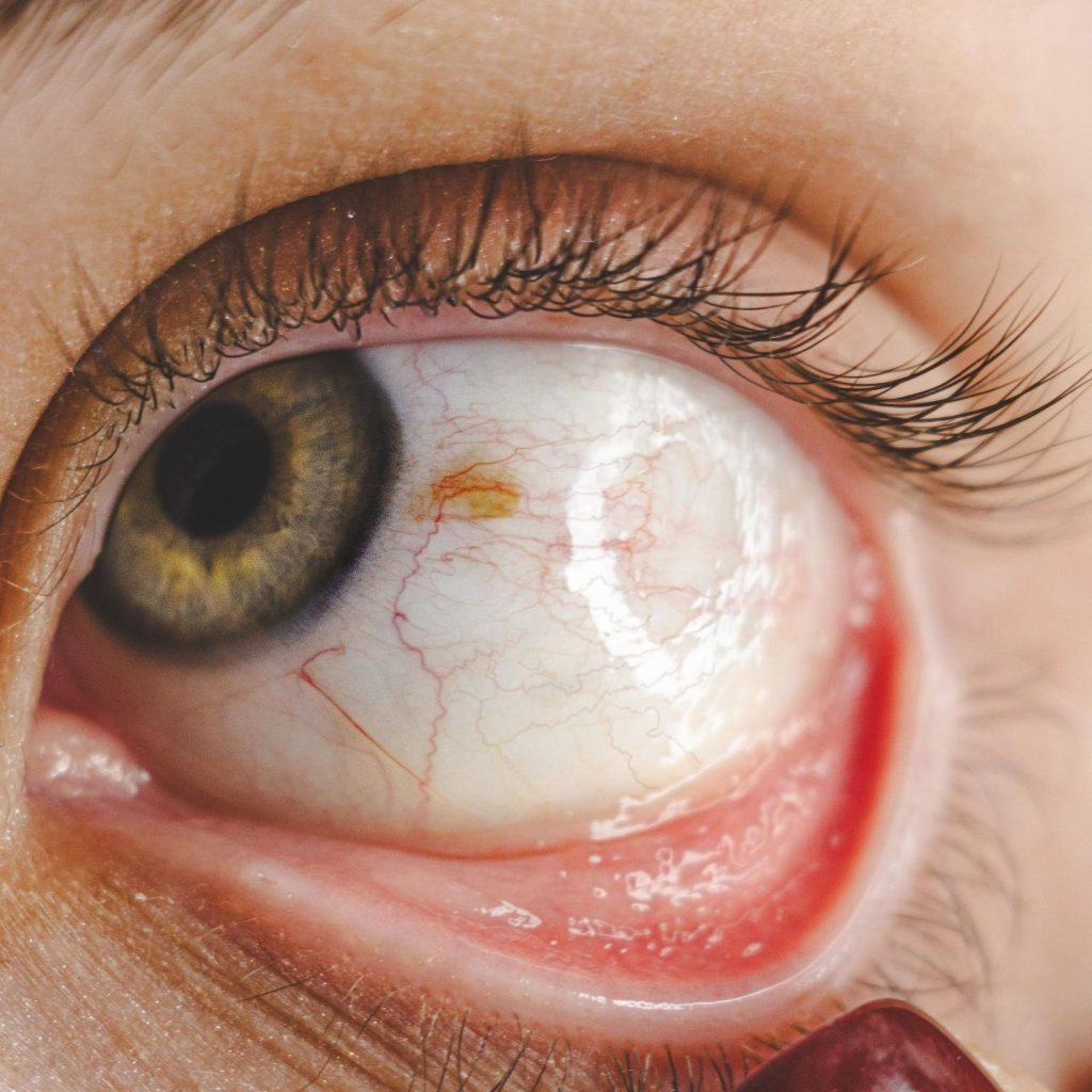 Baggy Eye Treatment