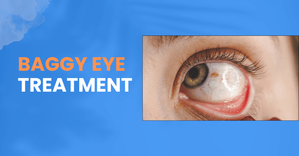Baggy Eye Treatment